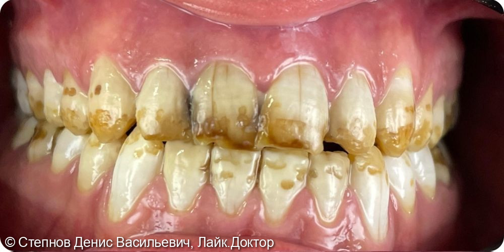 Эстетическая реставрация зубов при флюорозе - фото №1