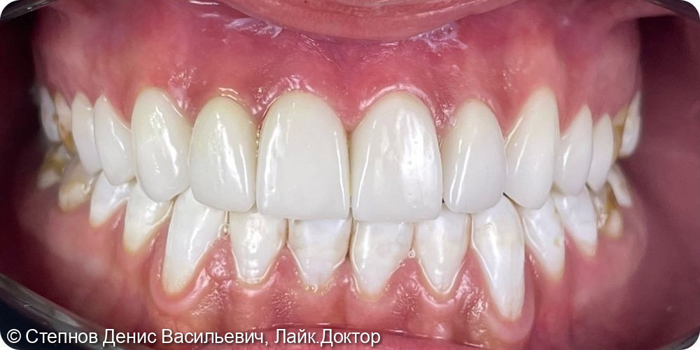 Эстетическая реставрация зубов при флюорозе - фото №2