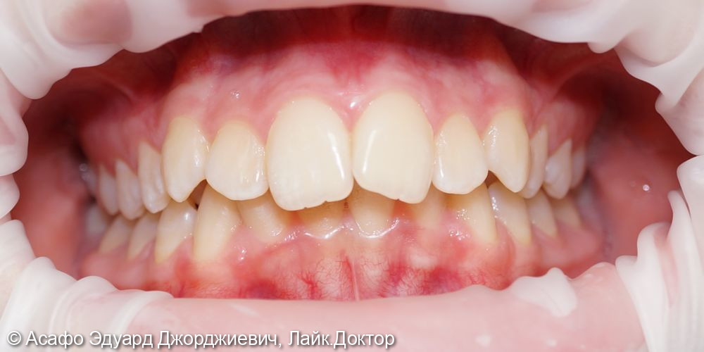 Сужение верхнего и нижнего зубного ряда - фото №1