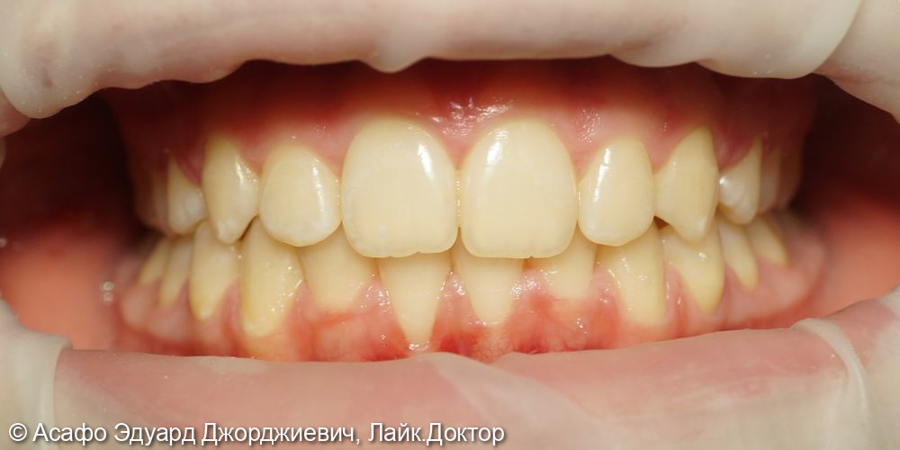 Сужение верхнего и нижнего зубного ряда - фото №4