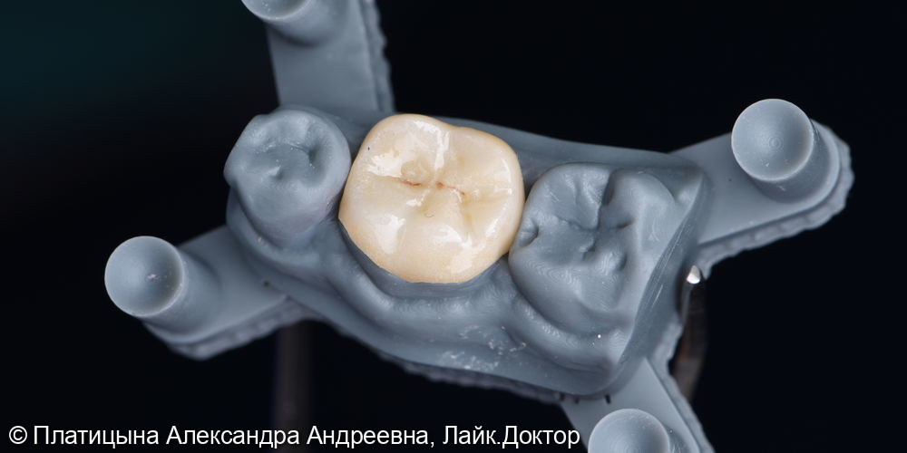 Восстановление зуба с помощью керамической накладки Emax - фото №2