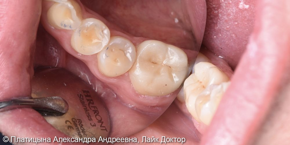 Восстановление зуба с помощью керамической накладки Emax - фото №3