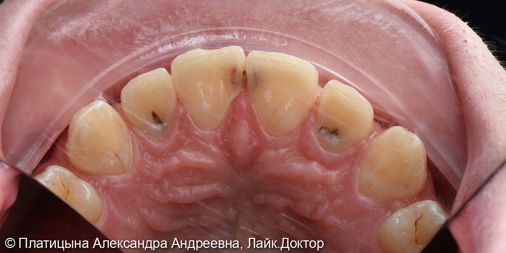 Лечение скрытого кариеса на фронтальных зубах- резцах верхней челюсти - фото №1