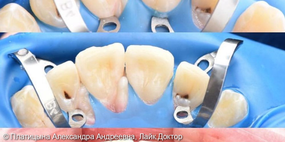 Лечение скрытого кариеса на фронтальных зубах- резцах верхней челюсти - фото №3