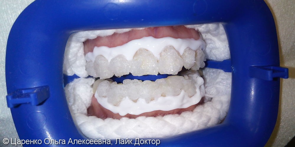 Результат отбеливания зубов системой ZOOM 4 - фото №2