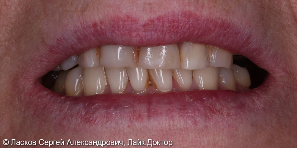 Протезирование зубов на верхней челюсти керамическими коронками - фото №1