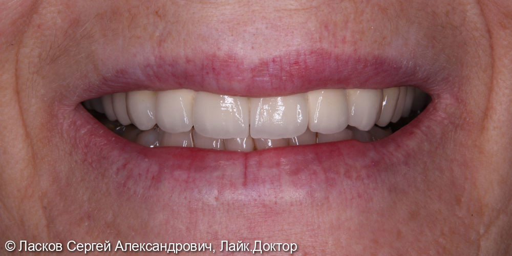 Протезирование зубов на верхней челюсти керамическими коронками - фото №2