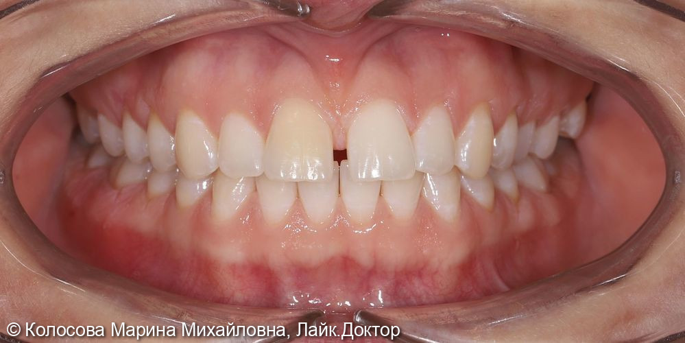 Ортодонтического лечение - фото №1