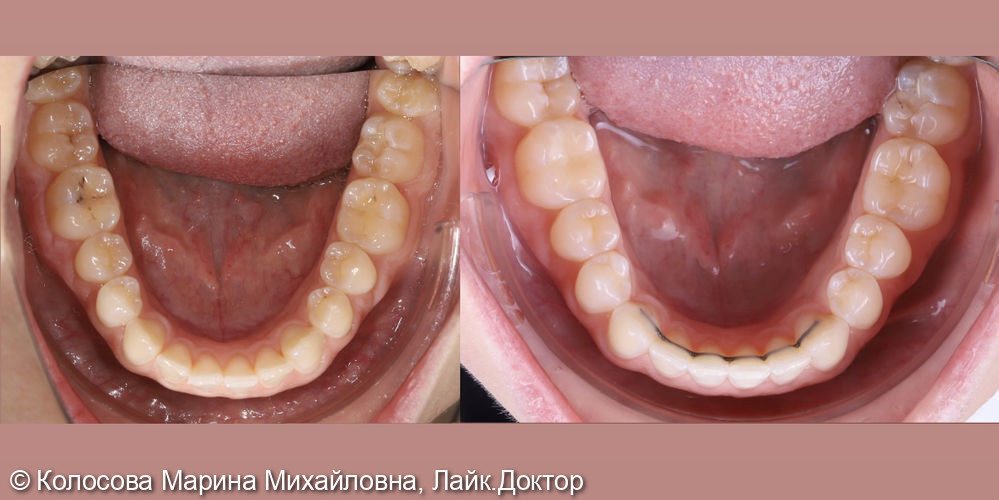 Ортодонтического лечение - фото №6