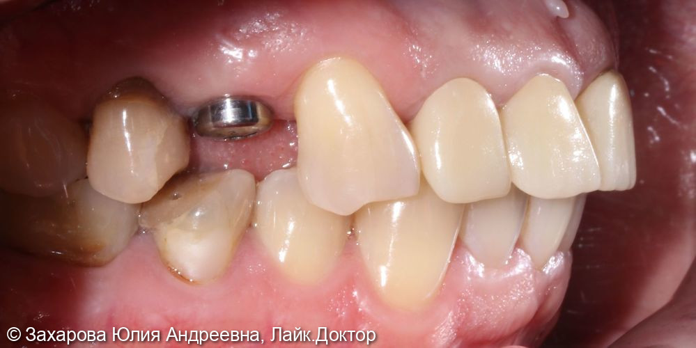Замещение частичного отсутствия зубов с опорой на имплантаты - фото №1