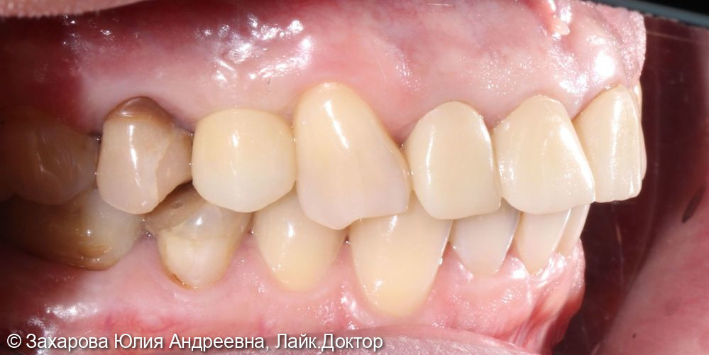 Замещение частичного отсутствия зубов с опорой на имплантаты - фото №2