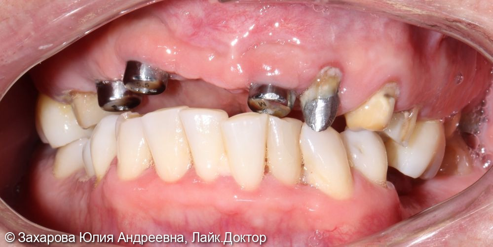 Замещение частичного отсутствия зубов на верхней челюсти - фото №1