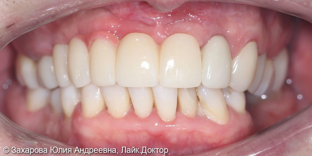 Замещение частичного отсутствия зубов на верхней челюсти - фото №2