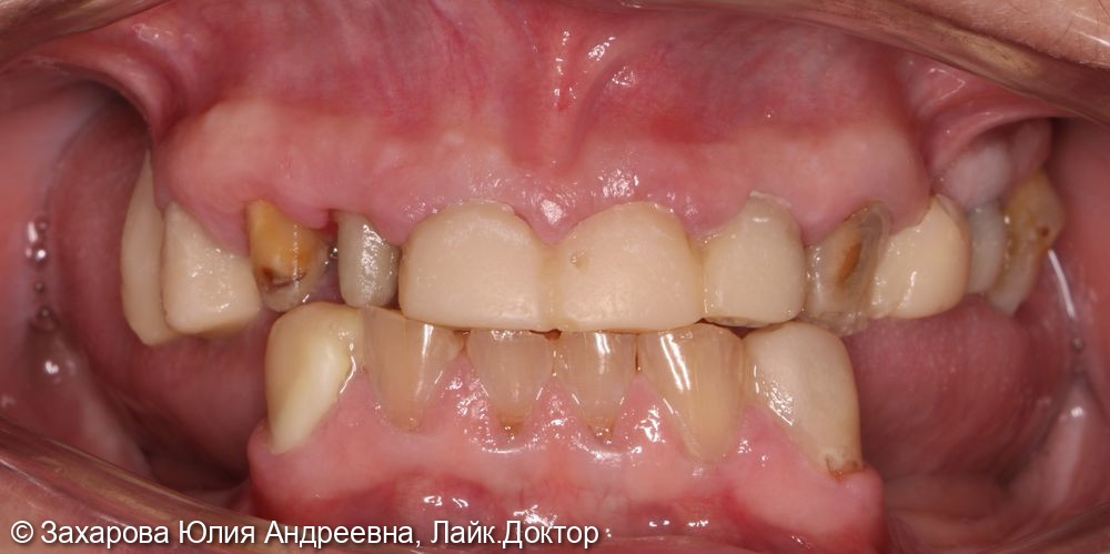 Восстановление зубов верхней и нижней челюсти - фото №1