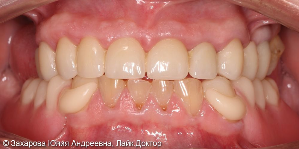 Восстановление зубов верхней и нижней челюсти - фото №4