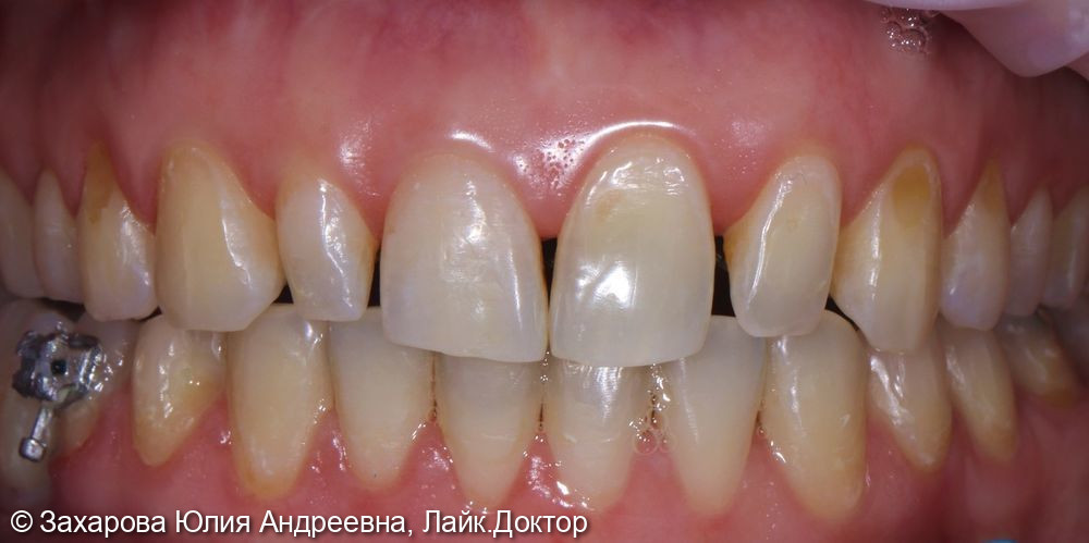 Реставрация фронтальной группы зубов керамическими винирами - фото №1