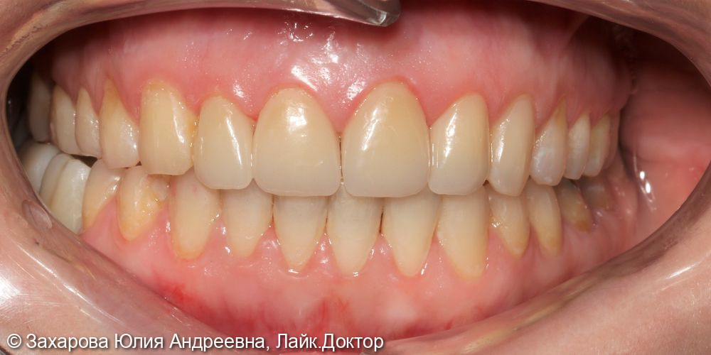 Реставрация фронтальной группы зубов керамическими винирами - фото №2