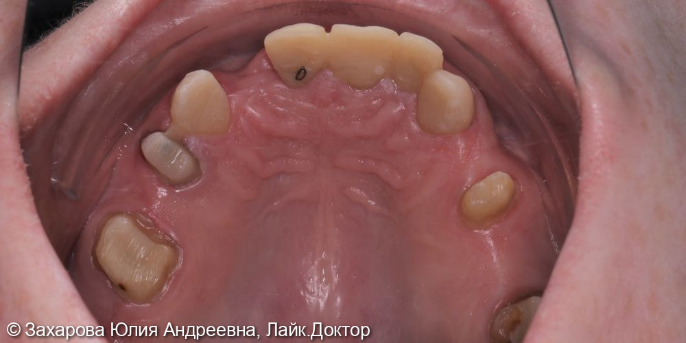 Восстановление анатомической формы передней группы зубов на верхней челюсти - фото №1