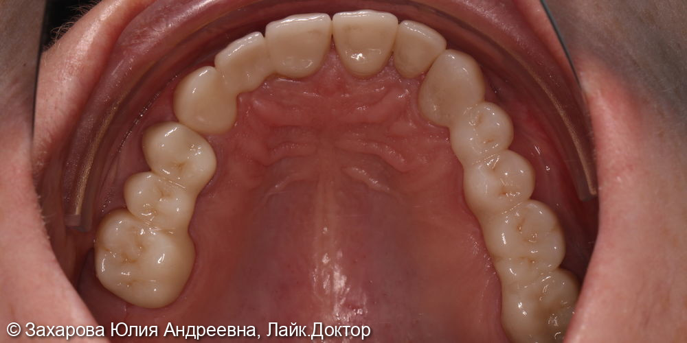 Восстановление анатомической формы передней группы зубов на верхней челюсти - фото №2