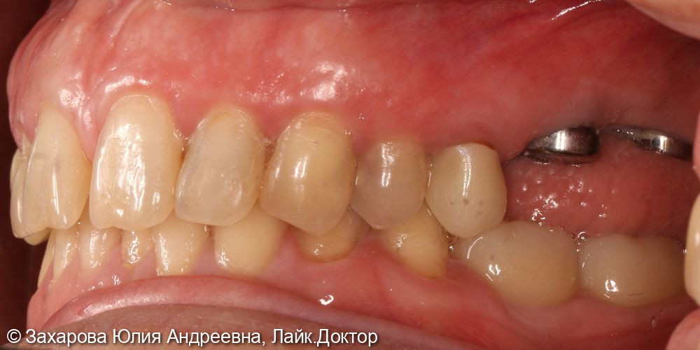 Восстановление частичного отсутствия зубов на верхней челюсти - фото №1