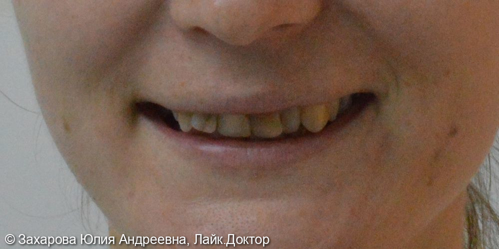 Восстановление фронтальной группы зубов - фото №1