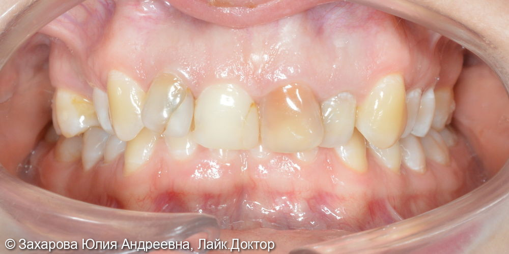 Восстановление фронтальной группы зубов - фото №2