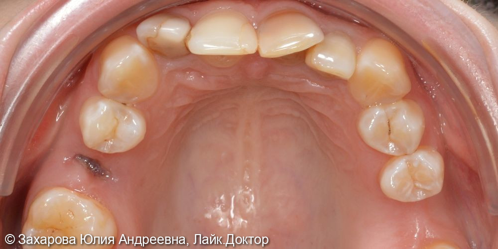 Восстановление фронтальной группы зубов - фото №4