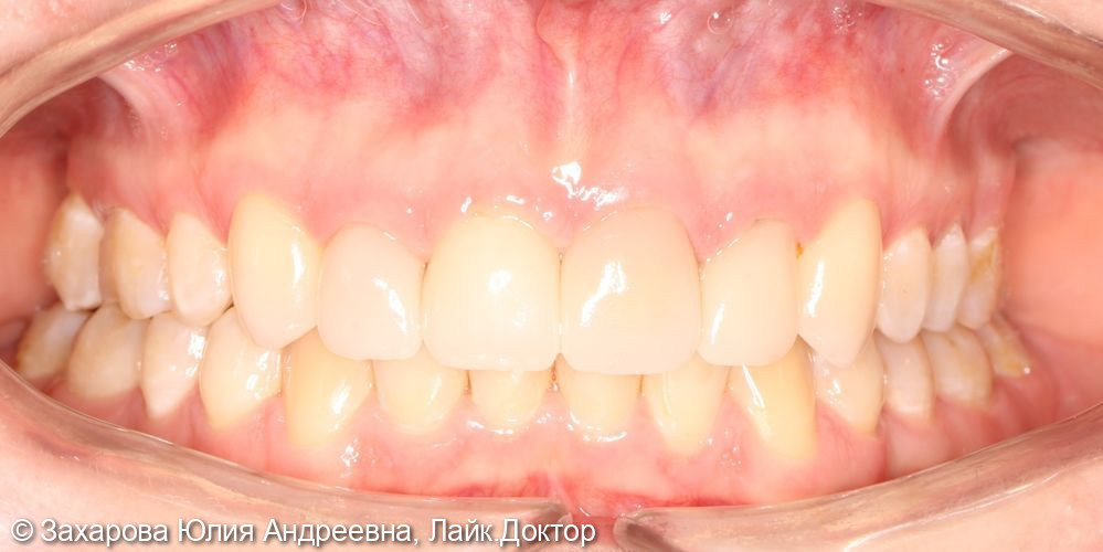 Восстановление фронтальной группы зубов - фото №3