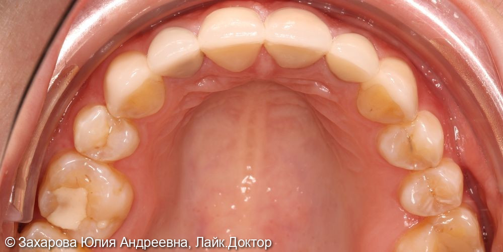 Восстановление фронтальной группы зубов - фото №5