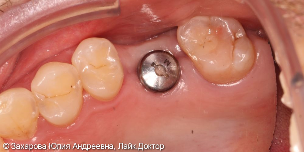 Замещение дефекта зубного ряда коронкой с опорой на имплантат - фото №1