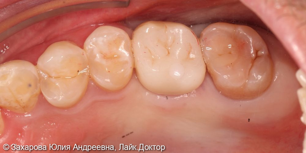 Замещение дефекта зубного ряда коронкой с опорой на имплантат - фото №2