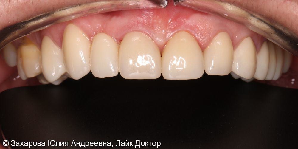 Восстановление зубов верхней челюсти циркониевыми коронками - фото №3