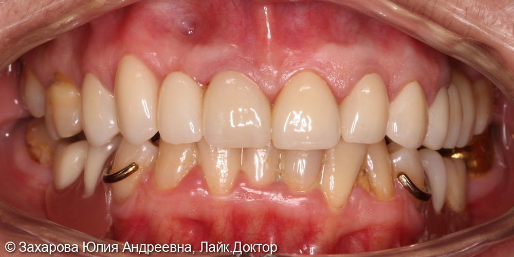 Восстановление зубов верхней челюсти циркониевыми коронками - фото №1