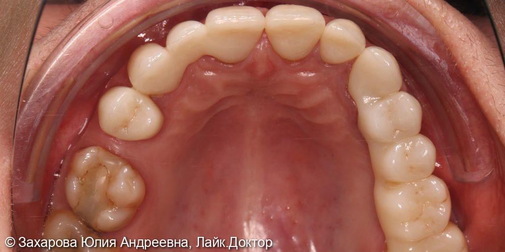 Восстановление зубов верхней челюсти циркониевыми коронками - фото №2