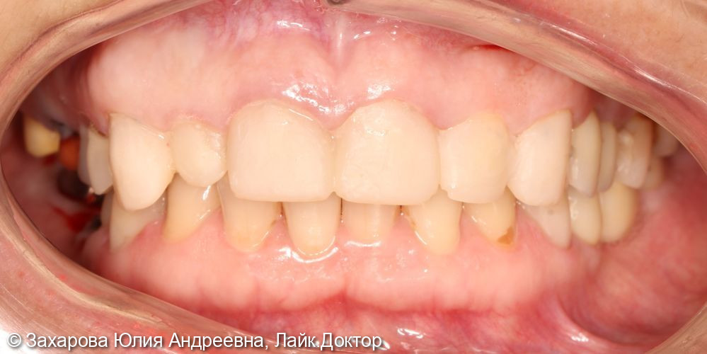 Восстановление Emax коронками и винирами. Замещение частичного отсутствия зубов циркониевыми коронками с опорой на имплантаты - фото №1