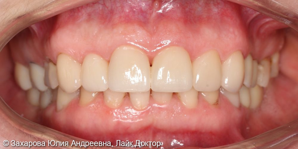 Восстановление Emax коронками и винирами. Замещение частичного отсутствия зубов циркониевыми коронками с опорой на имплантаты - фото №2