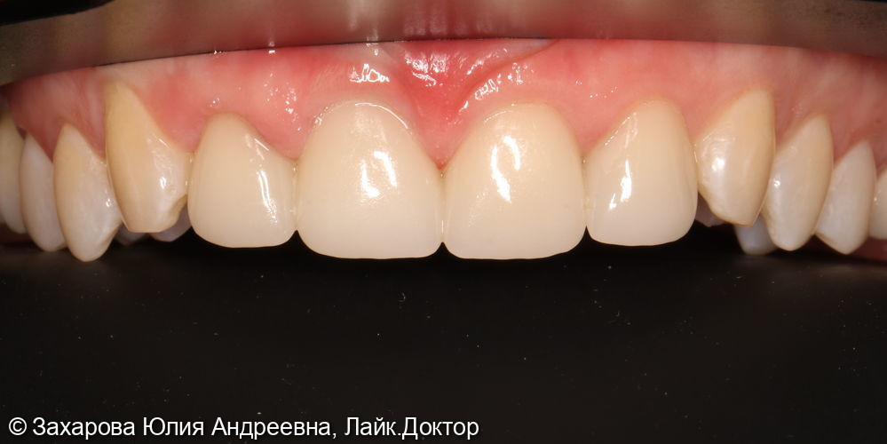 Восстановление Emax коронками и виниром фронтальных зубов верхней челюсти - фото №1