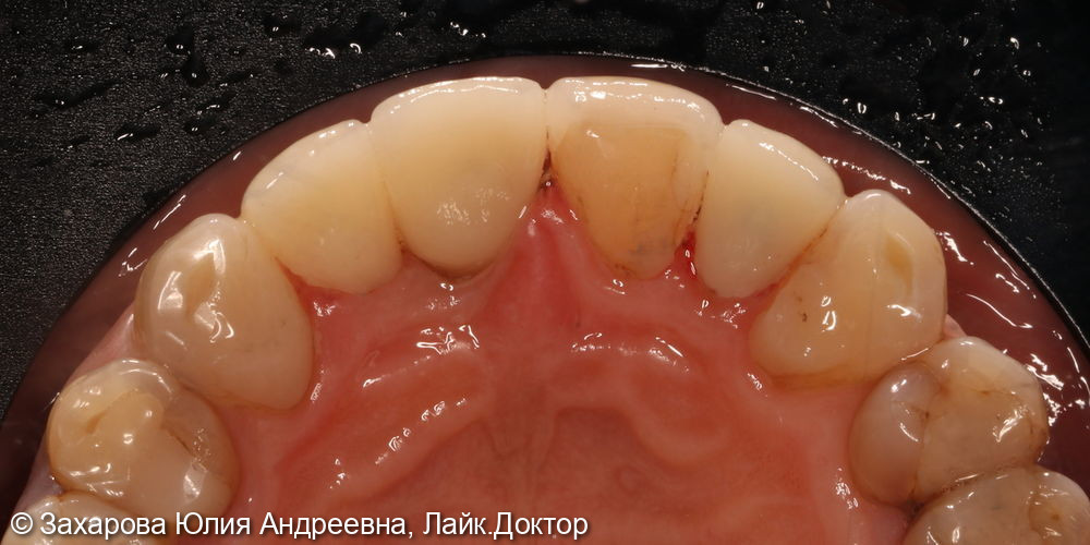 Восстановление Emax коронками и виниром фронтальных зубов верхней челюсти - фото №2