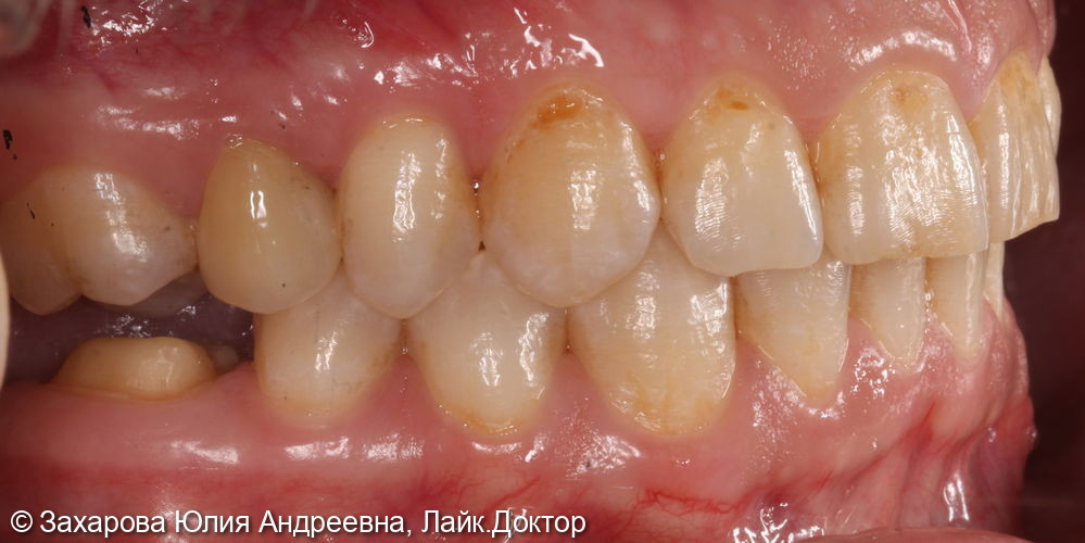 Восстановление анатомической целостности зуба металлокерамической коронкой - фото №2
