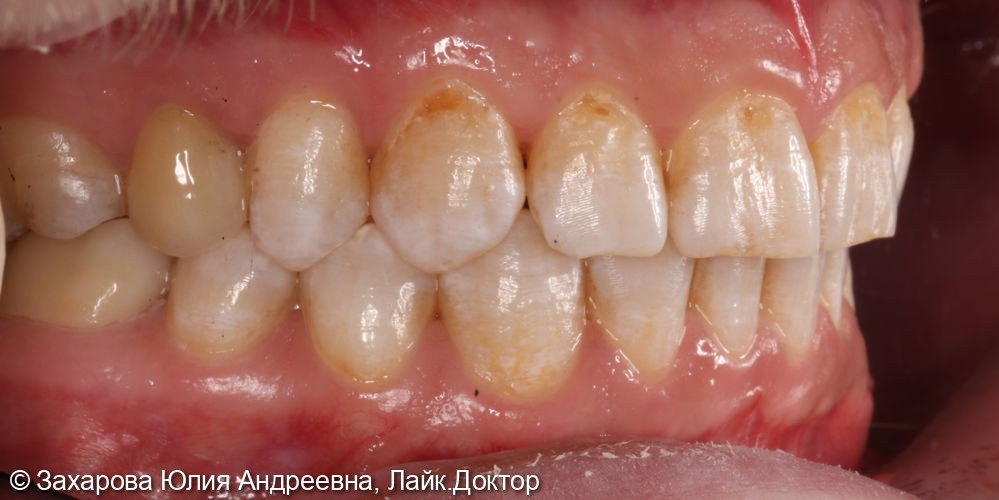 Восстановление анатомической целостности зуба металлокерамической коронкой - фото №3