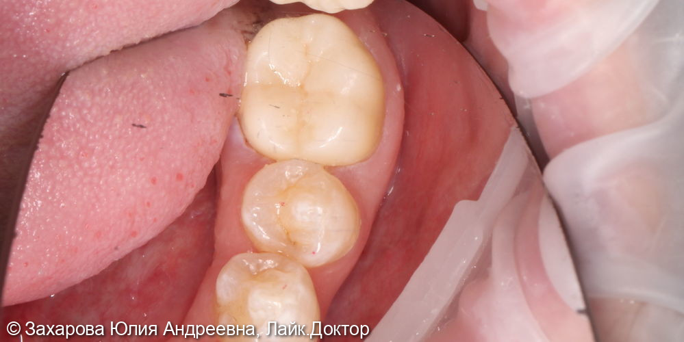 Восстановление анатомической целостности зуба металлокерамической коронкой - фото №4