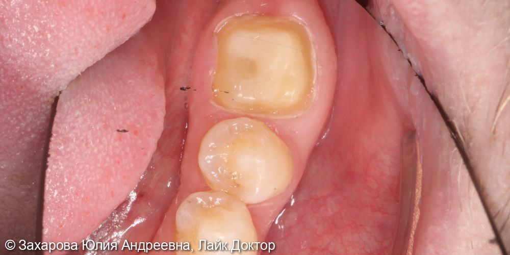 Восстановление анатомической целостности зуба металлокерамической коронкой - фото №1