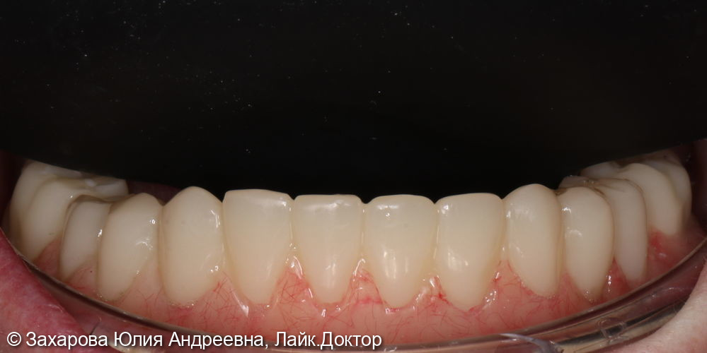 Протезирование полного отсутствия зубов - фото №5