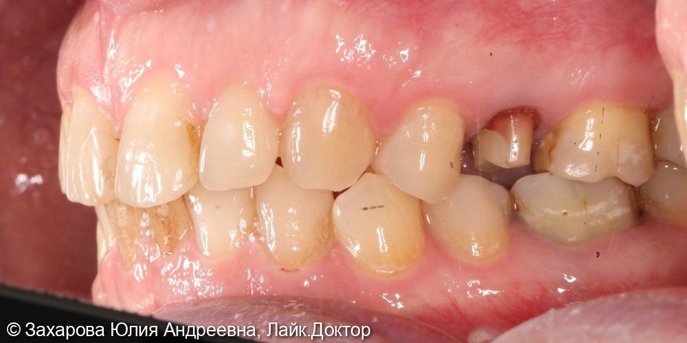 Восстановление анатомической целостности 15 зуба - фото №1
