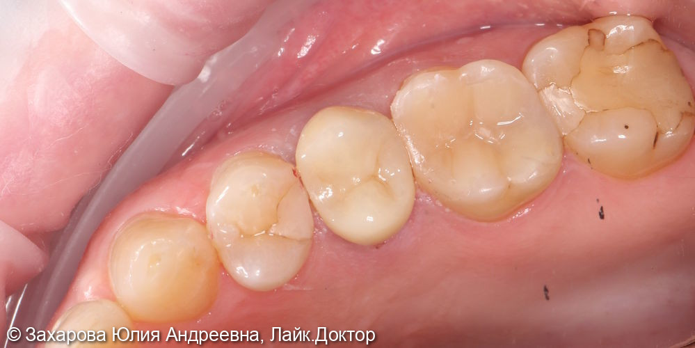Восстановление анатомической целостности 15 зуба - фото №2