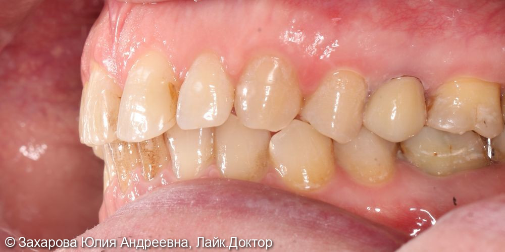 Восстановление анатомической целостности 15 зуба - фото №3
