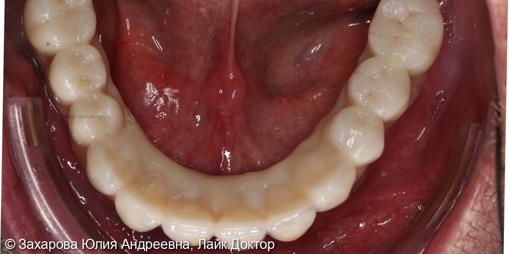 Замещение полного отсутствия зубов на верхней и нижней челюсти циркониевыми мостовидными конструкциями с опорой на имплантаты - фото №5