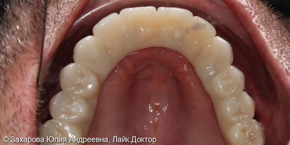 Замещение полного отсутствия зубов на верхней и нижней челюсти циркониевыми мостовидными конструкциями с опорой на имплантаты - фото №6
