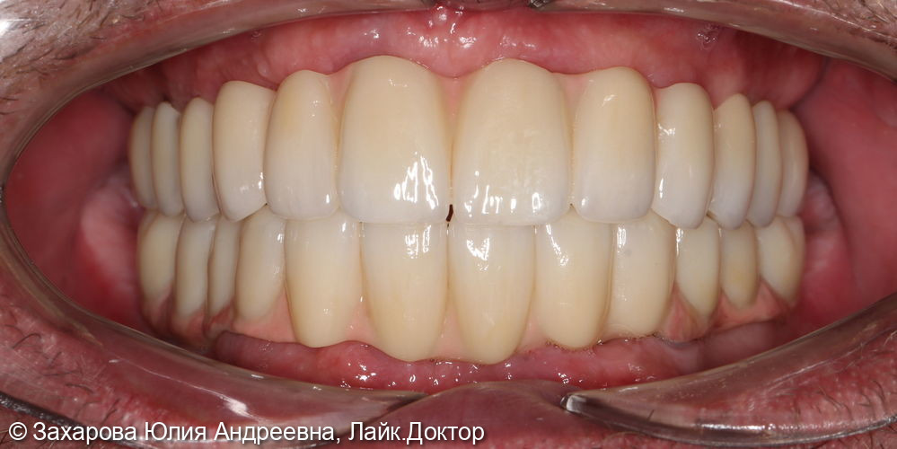 Замещение полного отсутствия зубов на верхней и нижней челюсти циркониевыми мостовидными конструкциями с опорой на имплантаты - фото №7