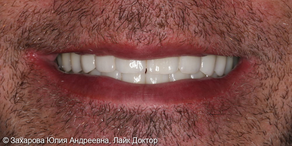 Замещение полного отсутствия зубов на верхней и нижней челюсти циркониевыми мостовидными конструкциями с опорой на имплантаты - фото №8